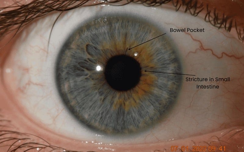 Eye anatomy close-up, highlighting bowel pocket and small intestine structure.