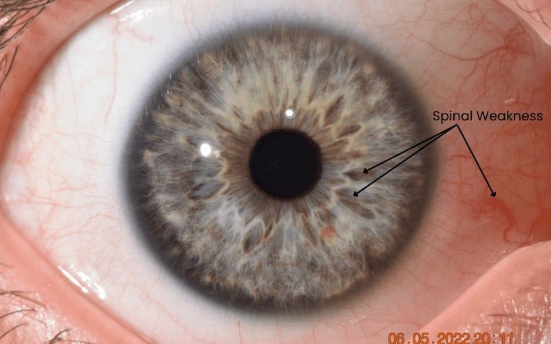 Eye with visible iris details and indications of spinal weakness affecting eye health.