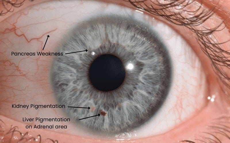 A detailed close-up of a human eye highlighting pancreas weakness, kidney pigmentation, and liver pigmentation on the adrenal area, emphasizing health diagnostics and holistic wellness.