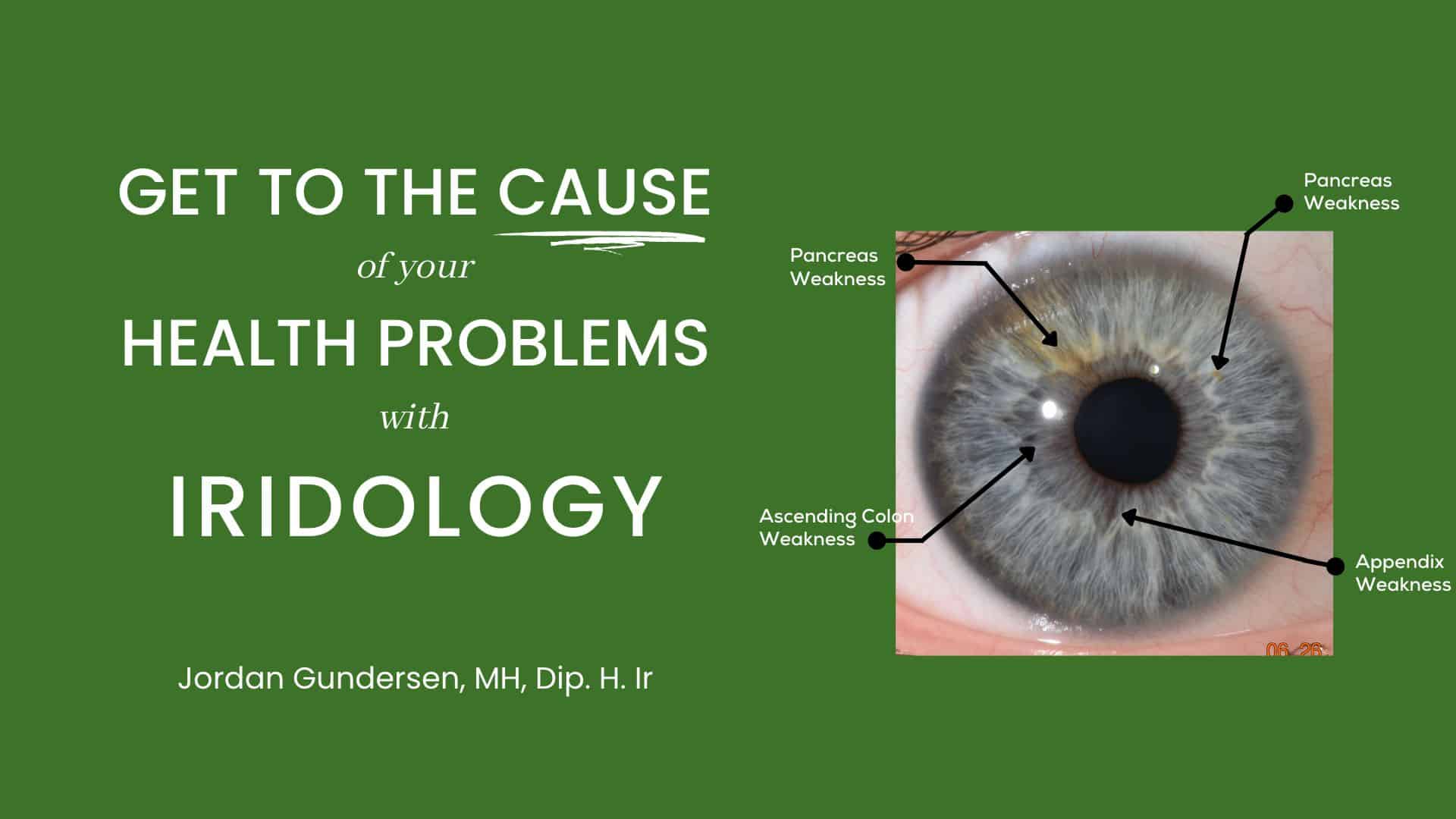 Iridology analysis of the eye revealing potential health issues and weaknesses, emphasizing the importance of holistic health assessment through eye examination.